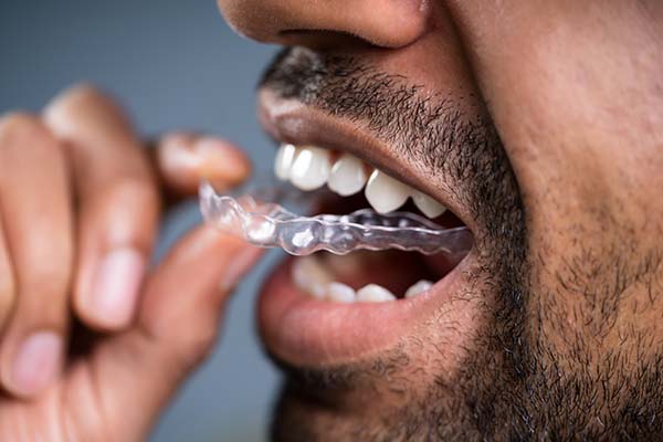 How Does Clear Aligners Teeth Straightening Work?
