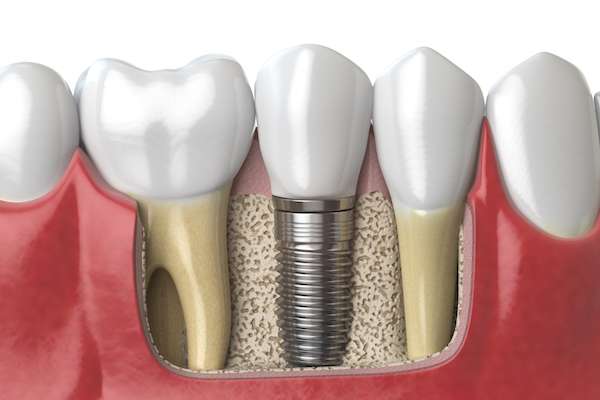 Dental Implants for Replacing Missing Teeth from The Dental Place of Tamarac in Tamarac, FL