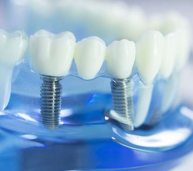 Tamarac Dental Implants