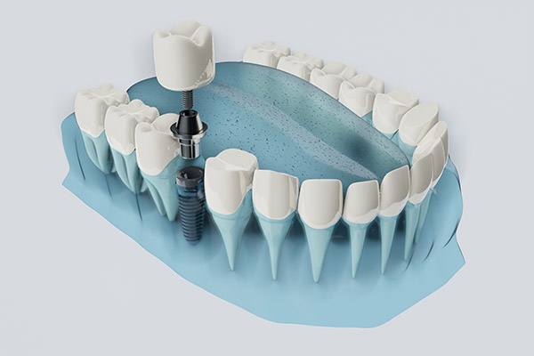 FAQs about Dental Implants from The Dental Place of Tamarac in Tamarac, FL