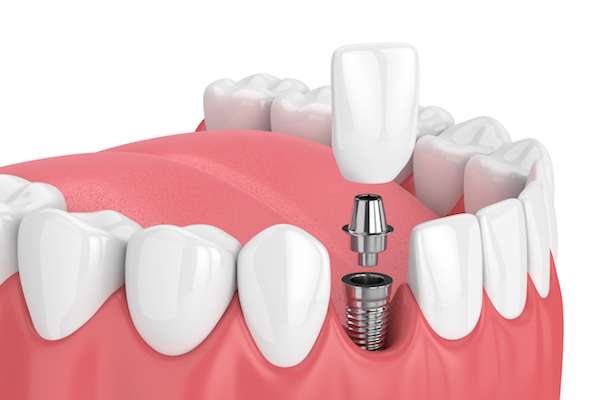 How Painful is Dental Implant Surgery from The Dental Place of Tamarac in Tamarac, FL