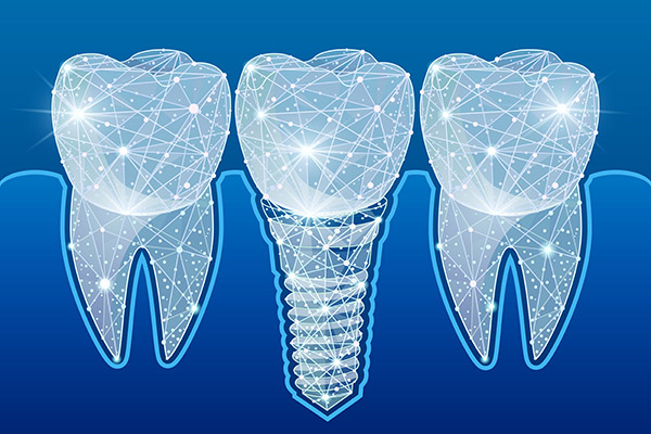 Preventing Complications After Getting Dental Implants from The Dental Place of Tamarac in Tamarac, FL