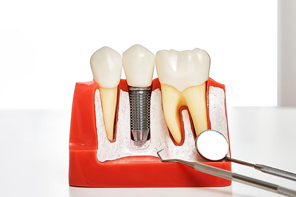 Your Guide to Different Kinds of Dental Implants from The Dental Place of Tamarac in Tamarac, FL