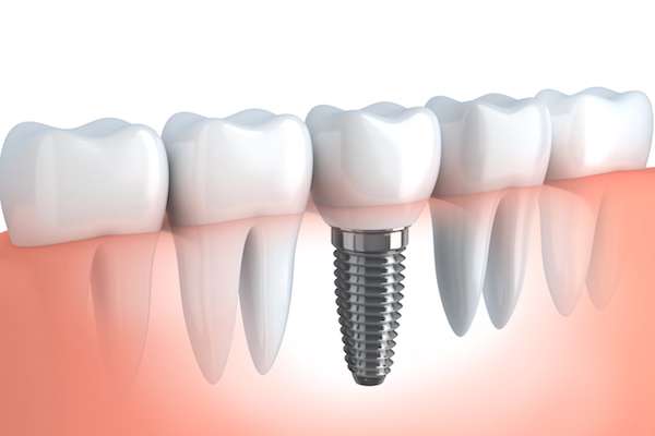 Your Ultimate Guide to Getting Dental Implants from The Dental Place of Tamarac in Tamarac, FL
